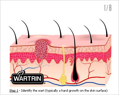 Genital Warts in Men: Wartrin