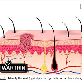 Genital Warts in Men: Wartrin